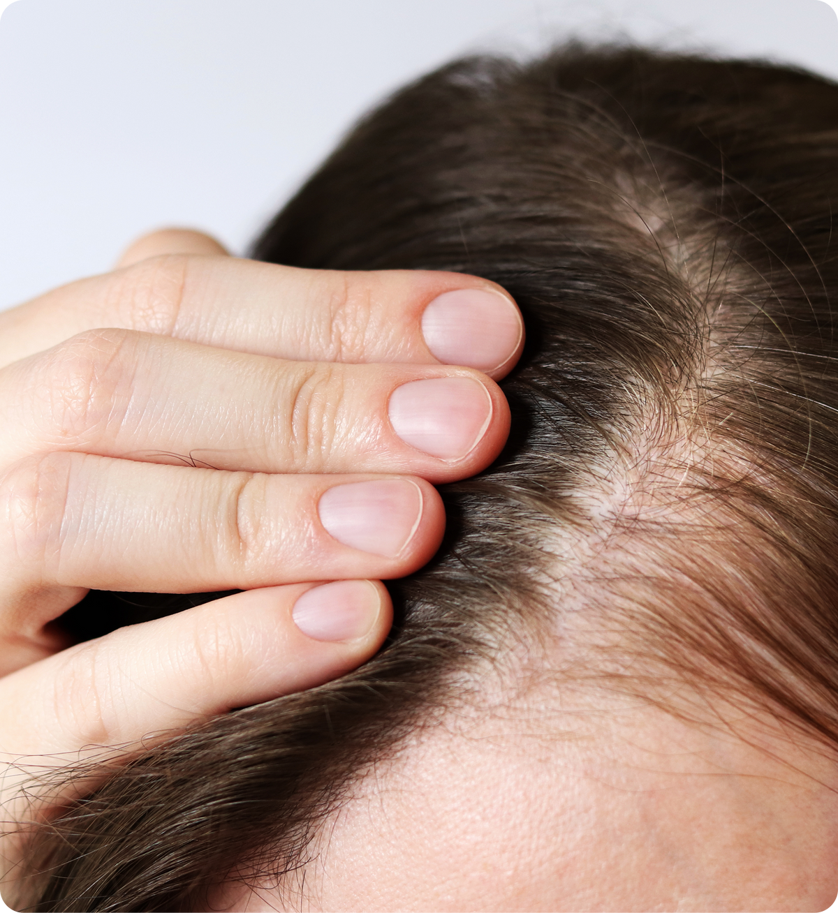 Fingers parting brown hair to reveal a thinning scalp and widening hair part near the hairline