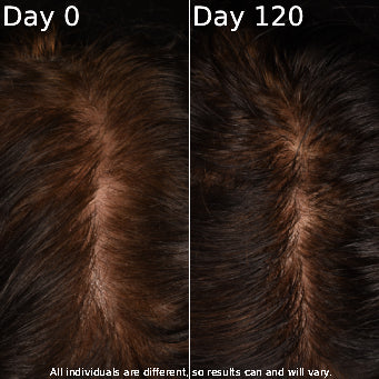 Comparison of hair density on Day 0 and Day 120 with a dark background.