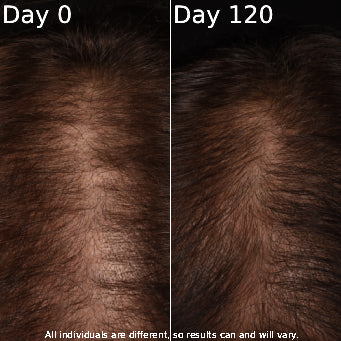 Before and after comparison of hair growth on Day 0 and Day 120.