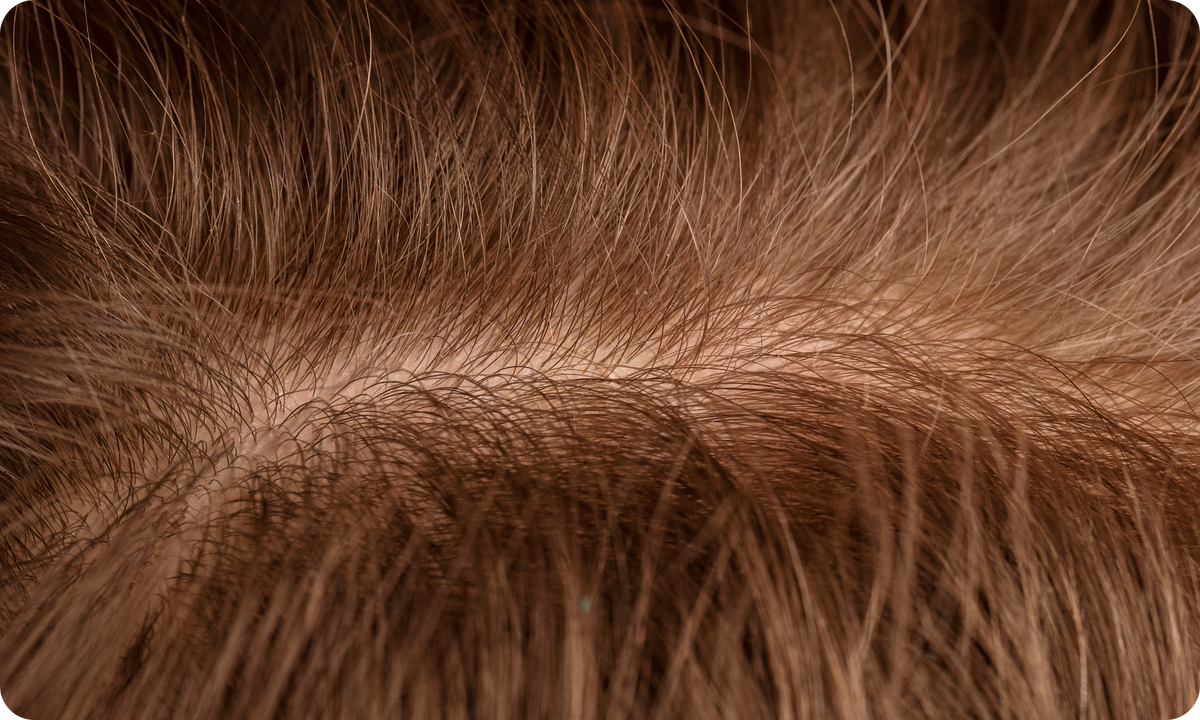 Close-up of a parted scalp showing thinning brown hair with visible scalp
